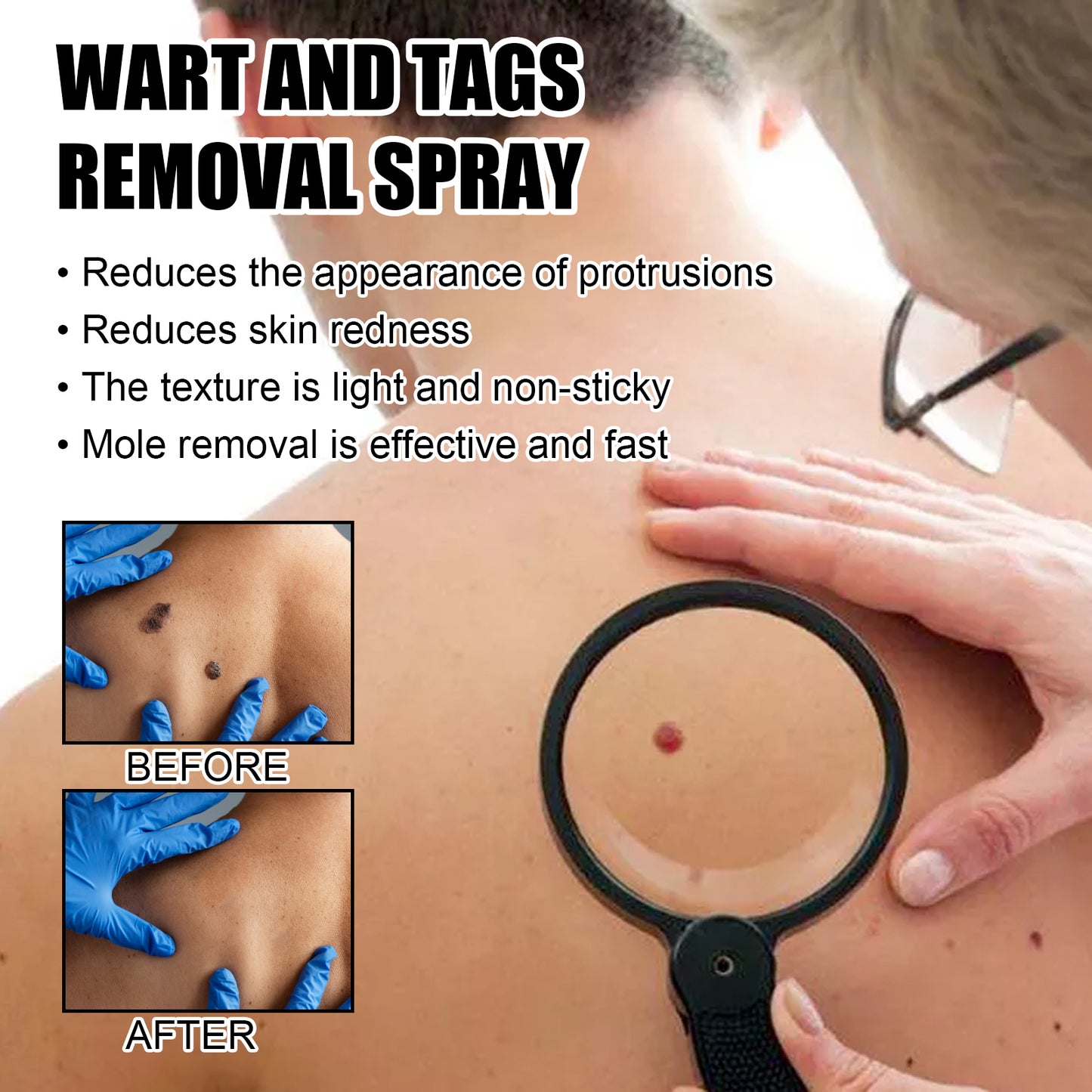 Wart And Tags Removal Spray, Cleanse And Fade Body Moles Smooth Skin Repair Spray