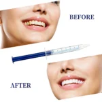 Vaclav Teeth Whitening Instrument Teeth whitening gels Peroxide Dental Bleaching System Teeth Whitening Light Kit 2